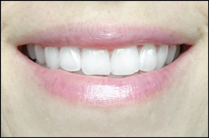 review of smile brilliant, smile brilliant teeth whitening kit, whitening teeth at home, dentist teeth whitening at home