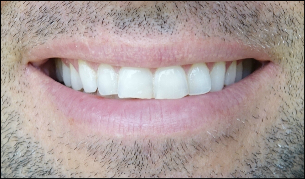 review smile brilliant, at home teeth whitening, custom teeth whitening reviews